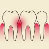 Cementoenamel Junction (CEJ, Cervical Line) | Gulf Coast Endodontics