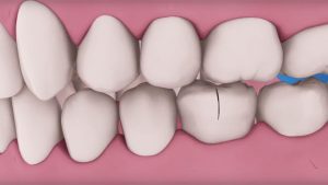 Traumatic teeth injury